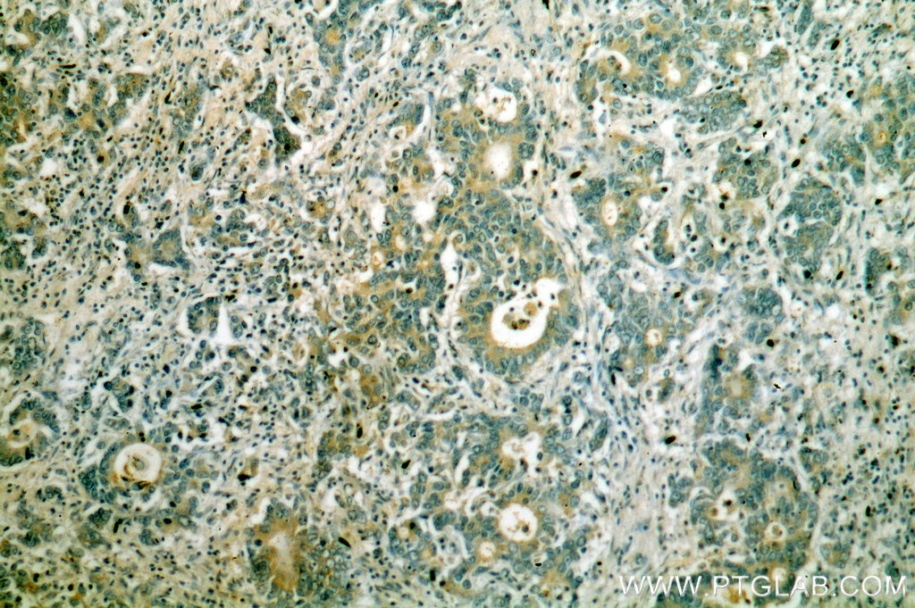 Immunohistochemistry (IHC) staining of human stomach cancer tissue using KRAS-2B-specific Polyclonal antibody (18294-1-AP)