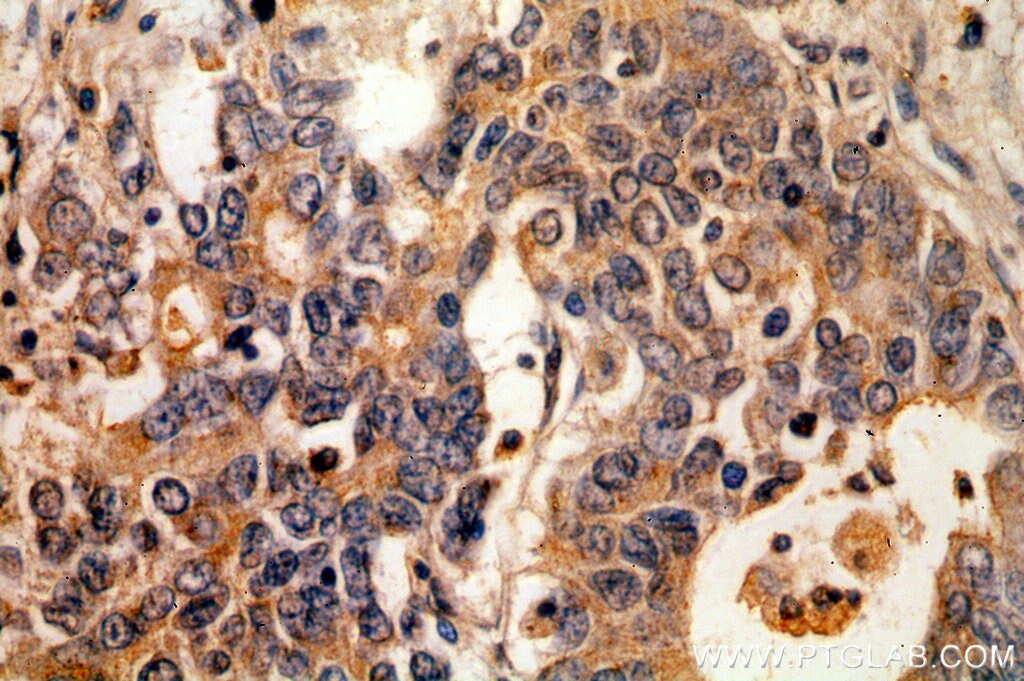 Immunohistochemistry (IHC) staining of human stomach cancer tissue using KRAS-2B-specific Polyclonal antibody (18294-1-AP)