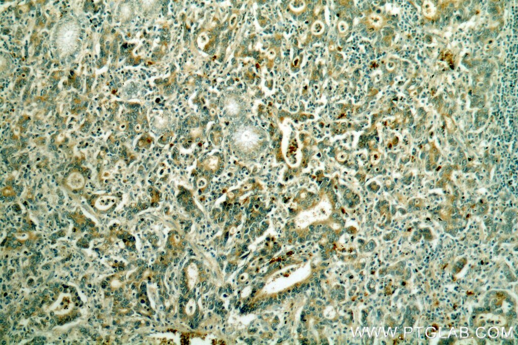 Immunohistochemistry (IHC) staining of human stomach cancer tissue using KRAS-2B-specific Polyclonal antibody (18294-1-AP)