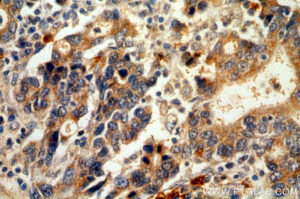 Immunohistochemistry (IHC) staining of human stomach cancer tissue using KRAS-2B-specific Polyclonal antibody (18294-1-AP)