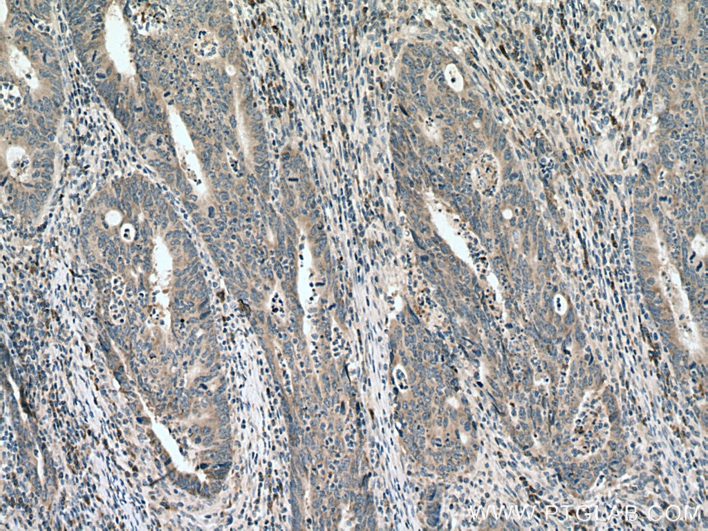 Immunohistochemistry (IHC) staining of human colon cancer tissue using KRAS-2B-specific Polyclonal antibody (16155-1-AP)