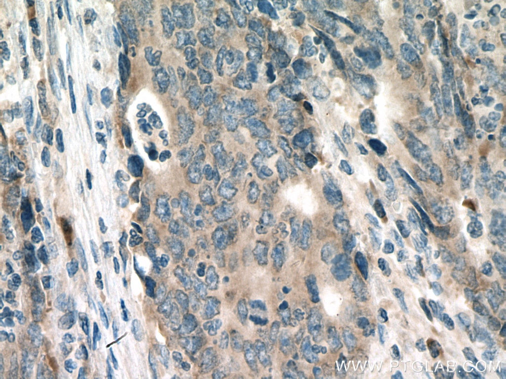 Immunohistochemistry (IHC) staining of human colon cancer tissue using KRAS-2B-specific Polyclonal antibody (16155-1-AP)