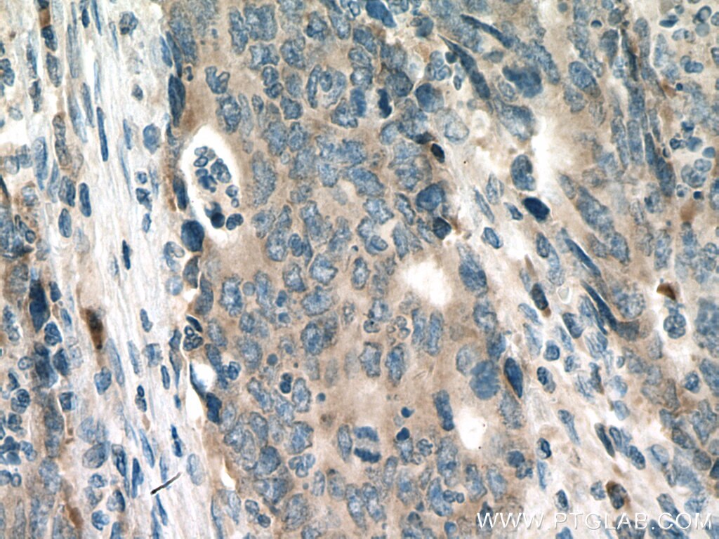 IHC staining of human colon cancer using 16155-1-AP