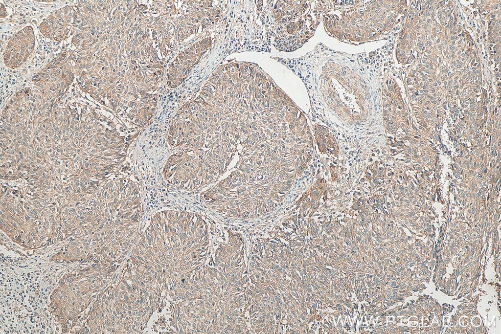 Immunohistochemistry (IHC) staining of human cervical cancer tissue using Cytokeratin 1-specific Polyclonal antibody (16848-1-AP)