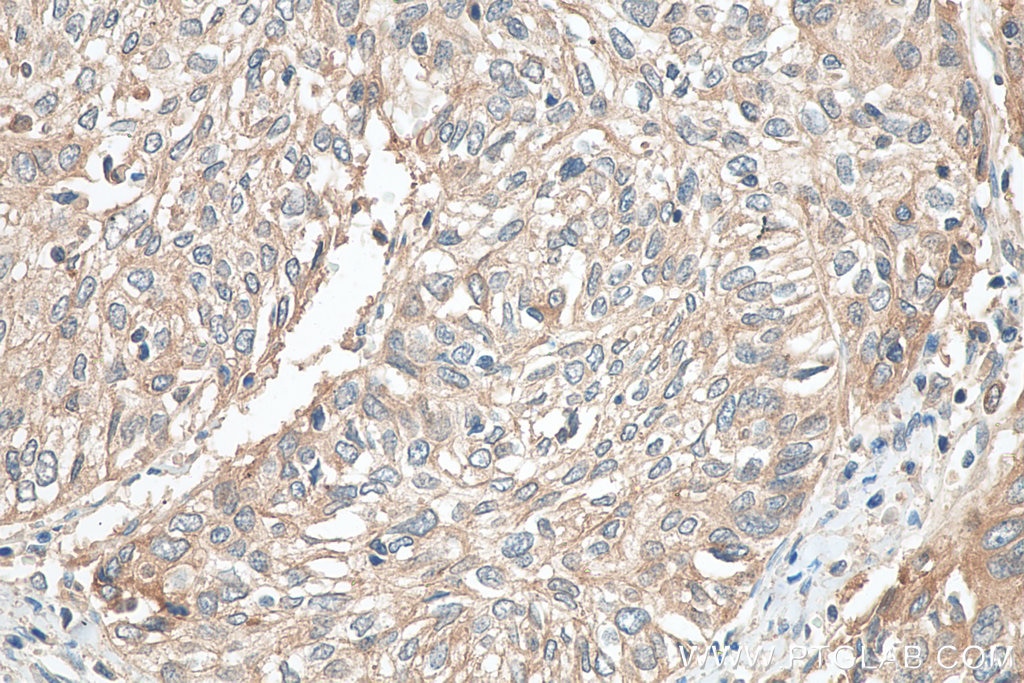 Immunohistochemistry (IHC) staining of human cervical cancer tissue using Cytokeratin 1-specific Polyclonal antibody (16848-1-AP)