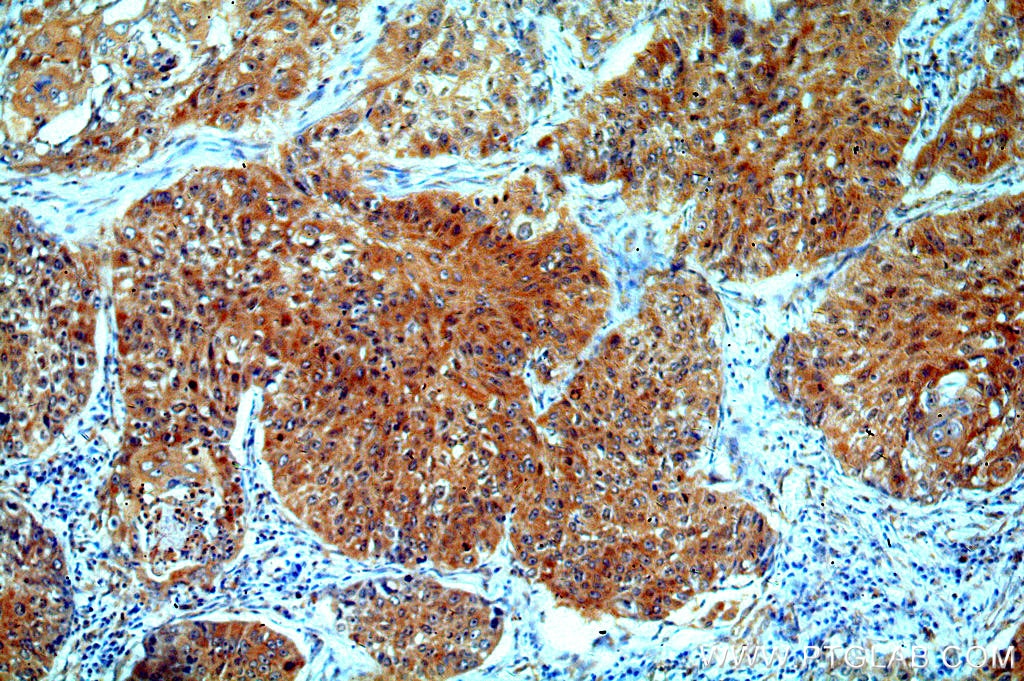 IHC staining of human lung cancer using 16848-1-AP