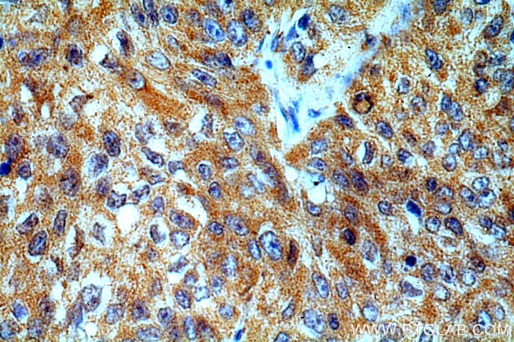 Immunohistochemistry (IHC) staining of human lung cancer tissue using Cytokeratin 1-specific Polyclonal antibody (16848-1-AP)