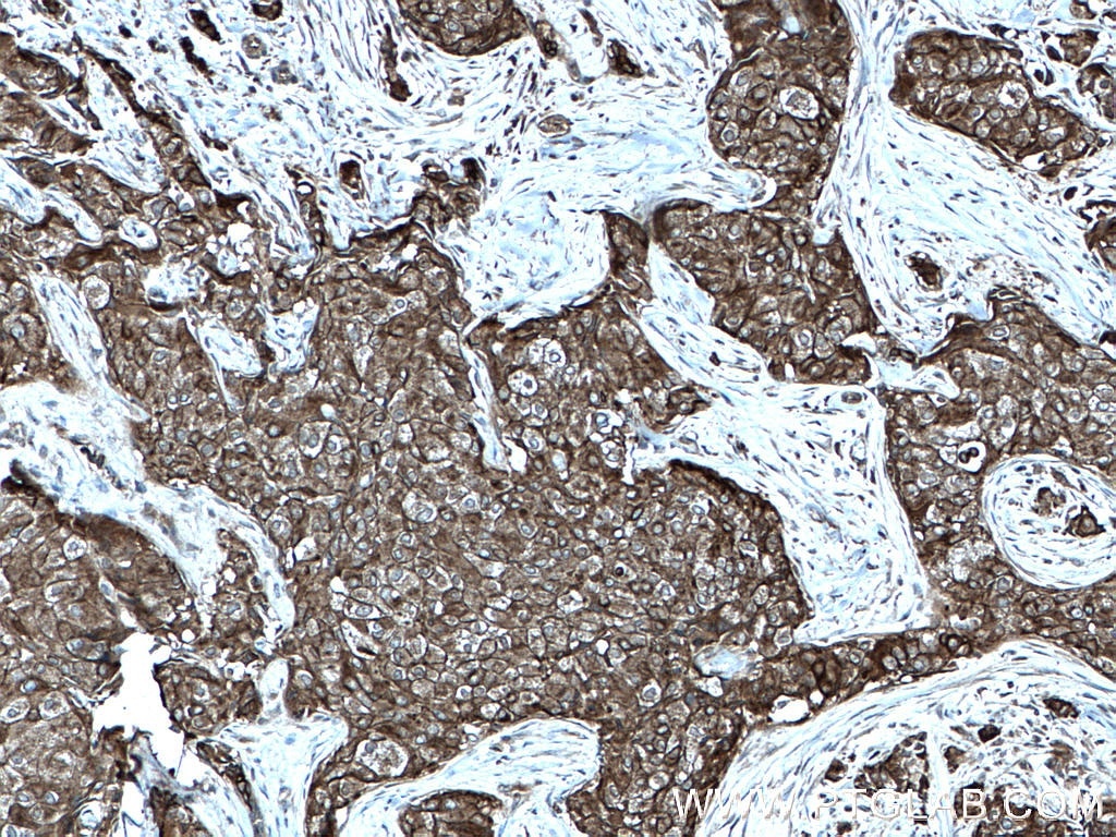 Immunohistochemistry (IHC) staining of human breast cancer tissue using Cytokeratin 10 Polyclonal antibody (18343-1-AP)