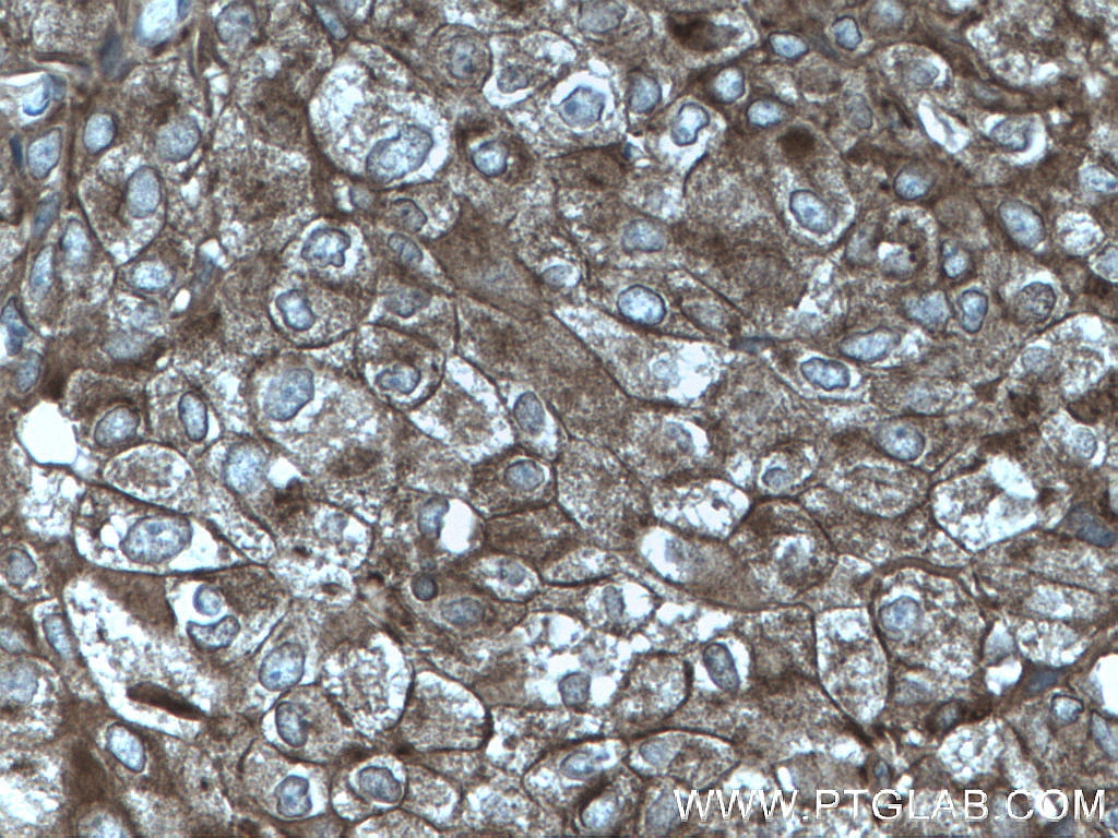 Immunohistochemistry (IHC) staining of human breast cancer tissue using Cytokeratin 10 Polyclonal antibody (18343-1-AP)