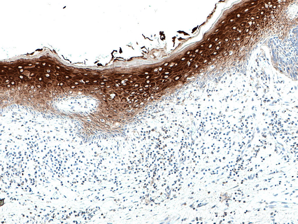 Immunohistochemistry (IHC) staining of human skin cancer tissue using Cytokeratin 10 Polyclonal antibody (18343-1-AP)
