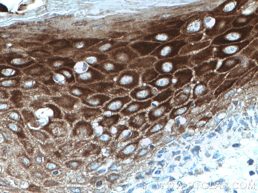 Immunohistochemistry (IHC) staining of human skin cancer tissue using Cytokeratin 10 Polyclonal antibody (18343-1-AP)