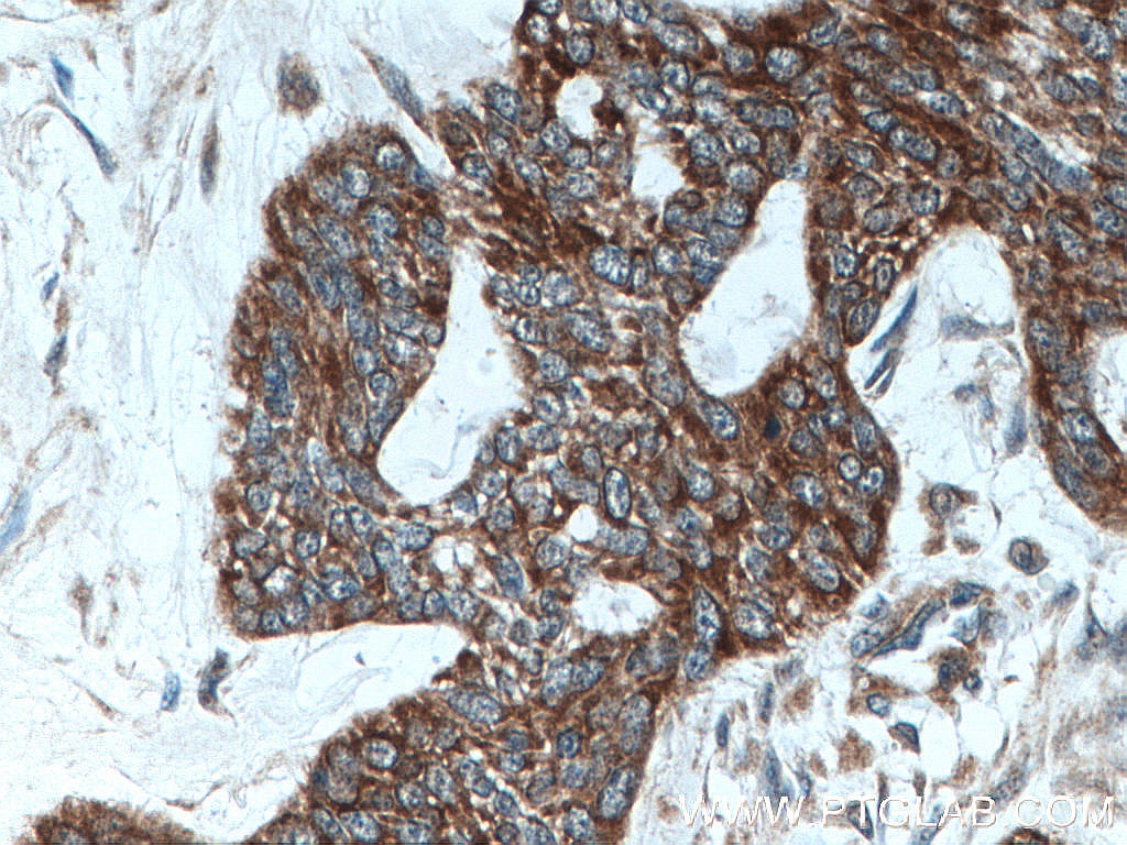 Immunohistochemistry (IHC) staining of human skin cancer tissue using Cytokeratin 10 Polyclonal antibody (18343-1-AP)