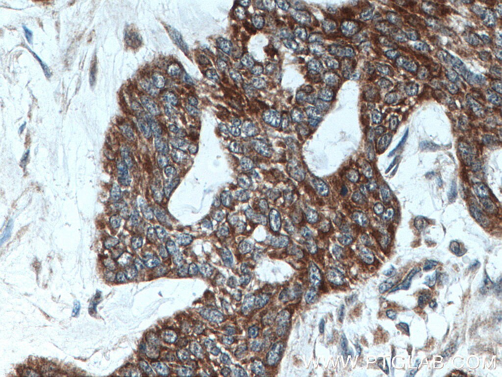 IHC staining of human skin cancer using 18343-1-AP