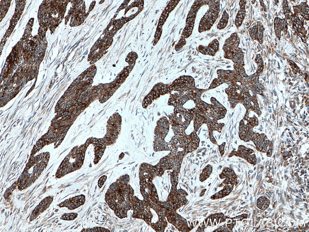 IHC staining of human skin cancer using 18343-1-AP