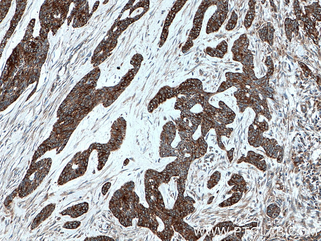 Immunohistochemistry (IHC) staining of human skin cancer tissue using Cytokeratin 10 Polyclonal antibody (18343-1-AP)