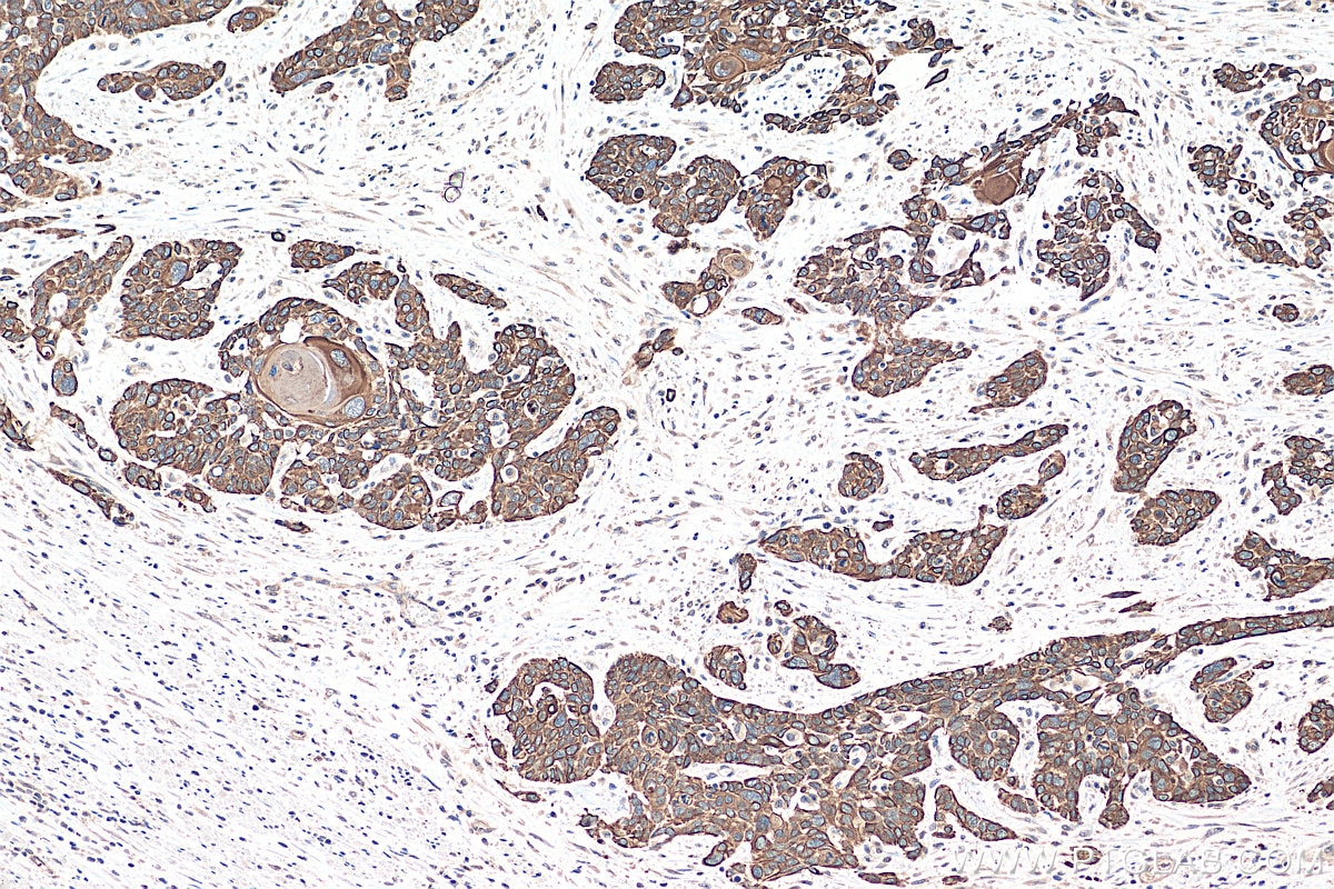 Immunohistochemistry (IHC) staining of human oesophagus cancer tissue using Cytokeratin 10 Polyclonal antibody (18343-1-PBS)