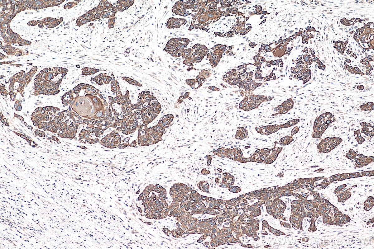 IHC staining of human oesophagus cancer using 18343-1-PBS