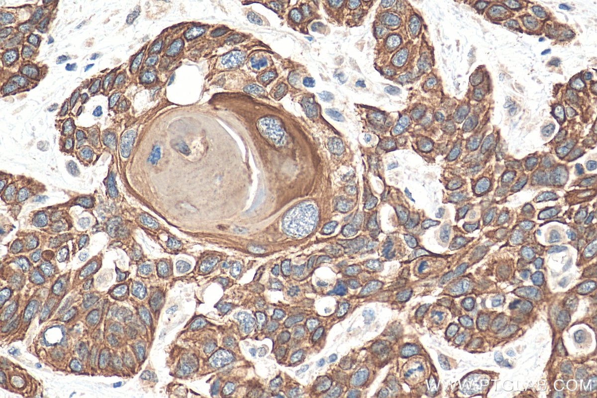 Immunohistochemistry (IHC) staining of human oesophagus cancer tissue using Cytokeratin 10 Polyclonal antibody (18343-1-PBS)