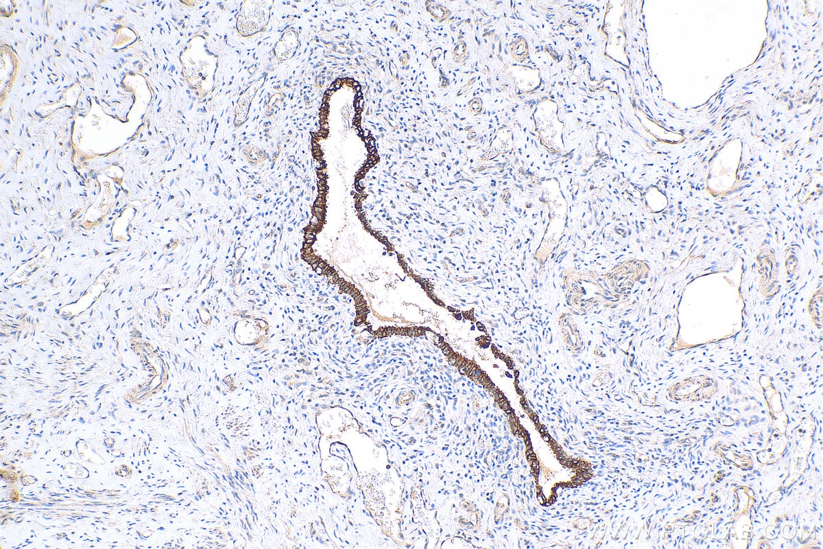 Immunohistochemistry (IHC) staining of human cervical cancer tissue using Cytokeratin 10 Polyclonal antibody (18343-1-AP)