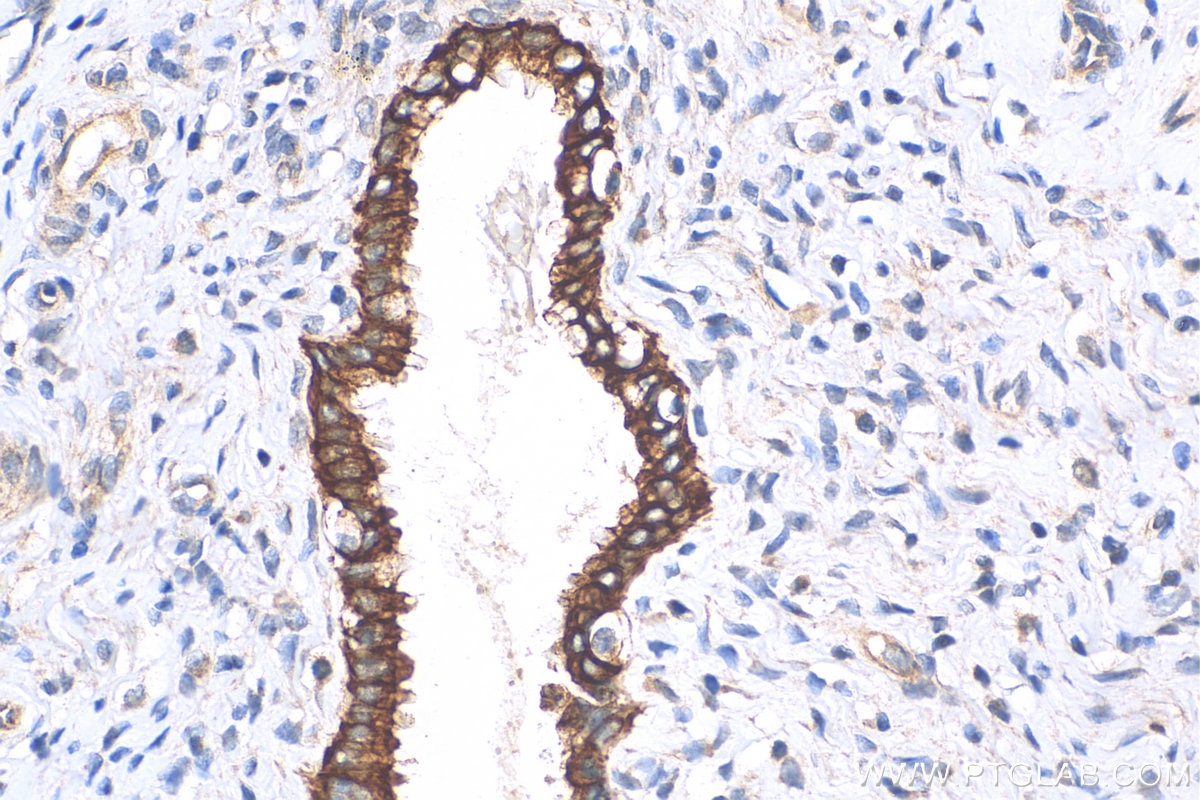 Immunohistochemistry (IHC) staining of human cervical cancer tissue using Cytokeratin 10 Polyclonal antibody (18343-1-AP)