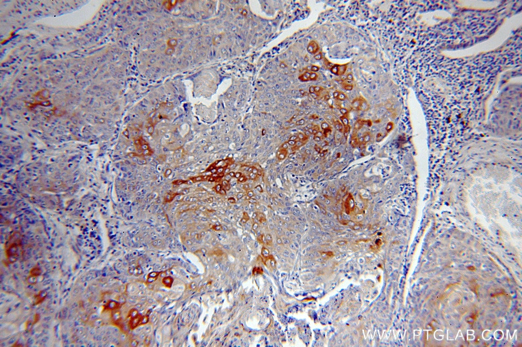 Immunohistochemistry (IHC) staining of human lung cancer tissue using Cytokeratin 10 Polyclonal antibody (18343-1-AP)