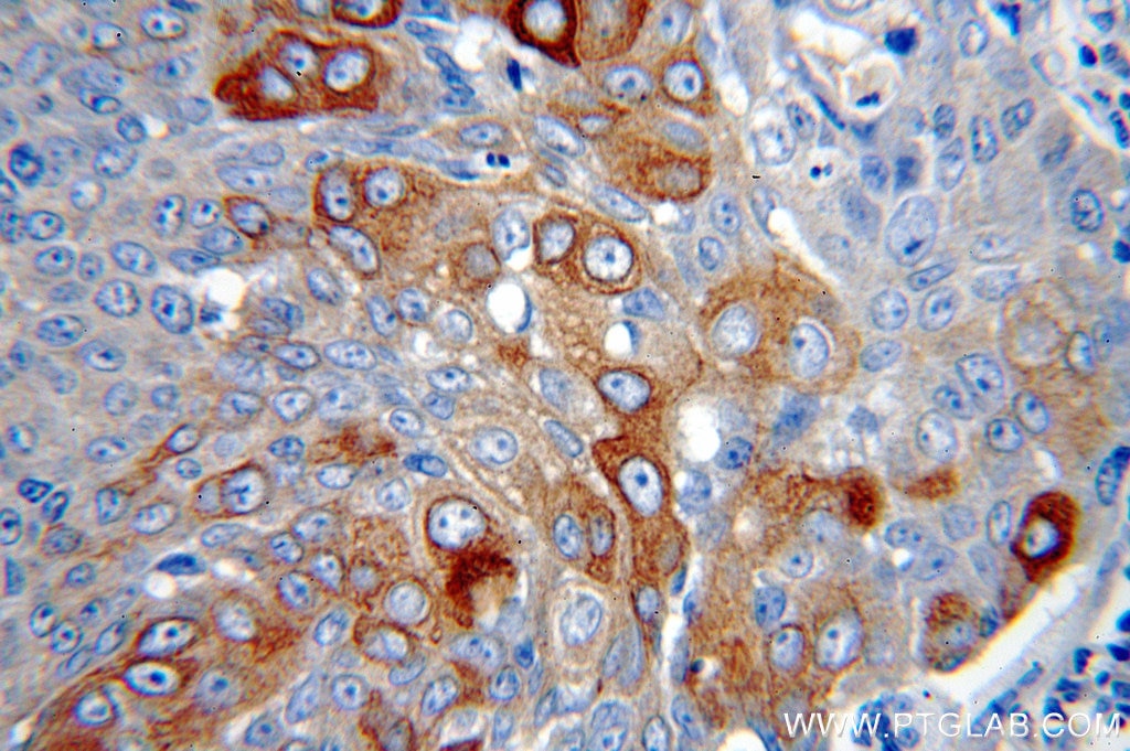Immunohistochemistry (IHC) staining of human lung cancer tissue using Cytokeratin 10 Polyclonal antibody (18343-1-AP)