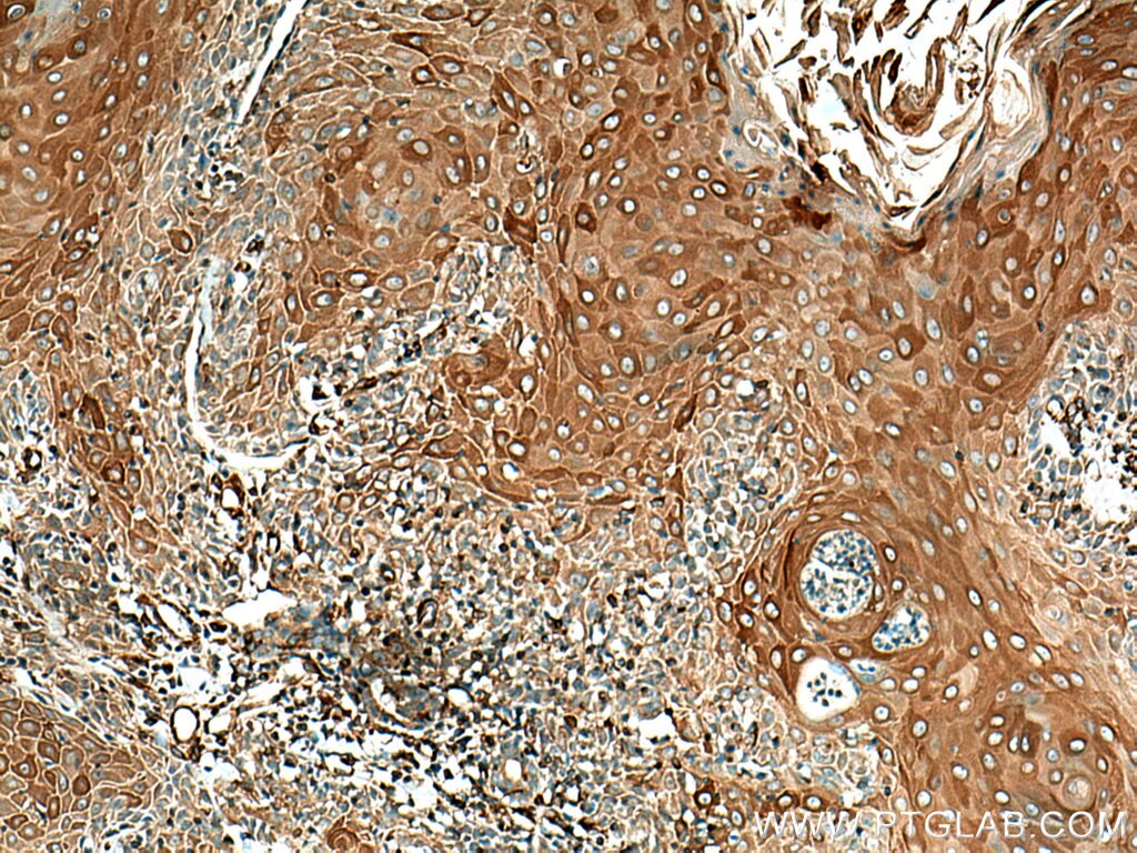 Immunohistochemistry (IHC) staining of human skin cancer tissue using Cytokeratin 10-specific Polyclonal antibody (16855-1-AP)