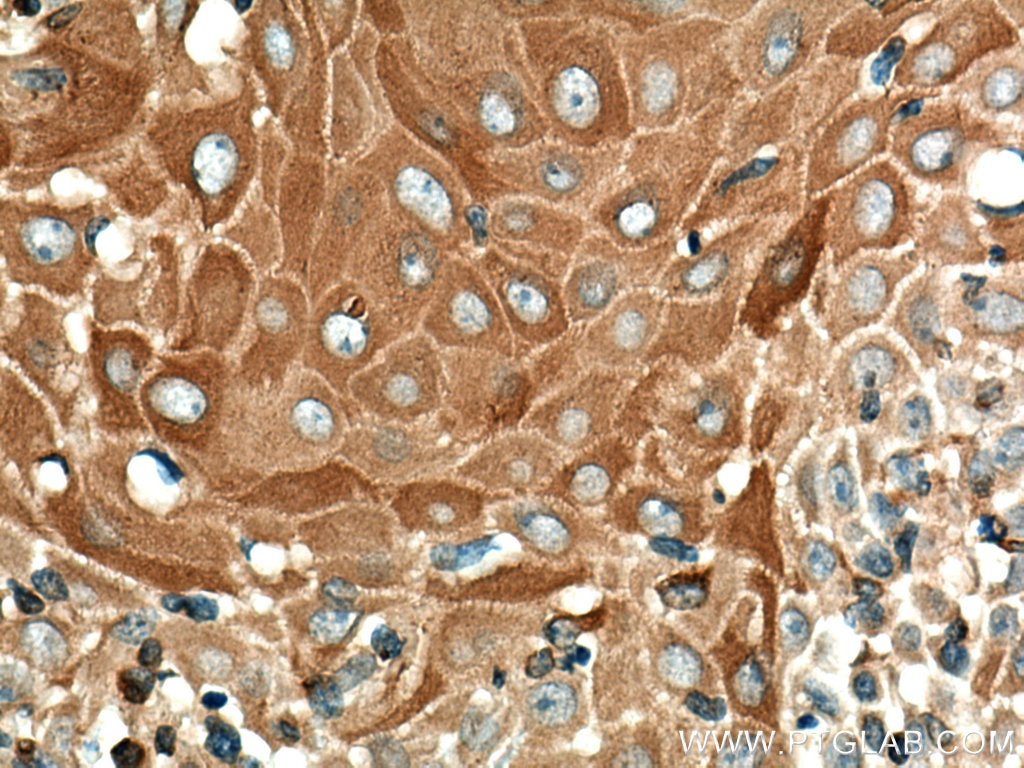 IHC staining of human skin cancer using 16855-1-AP