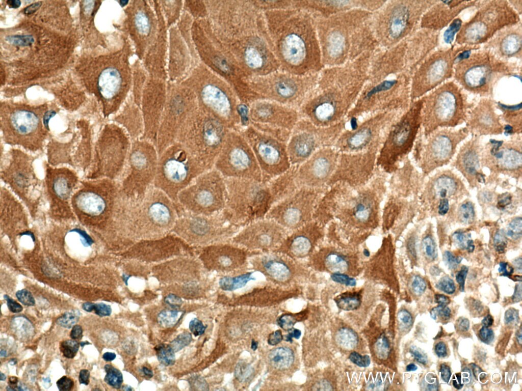 Immunohistochemistry (IHC) staining of human skin cancer tissue using Cytokeratin 10-specific Polyclonal antibody (16855-1-AP)