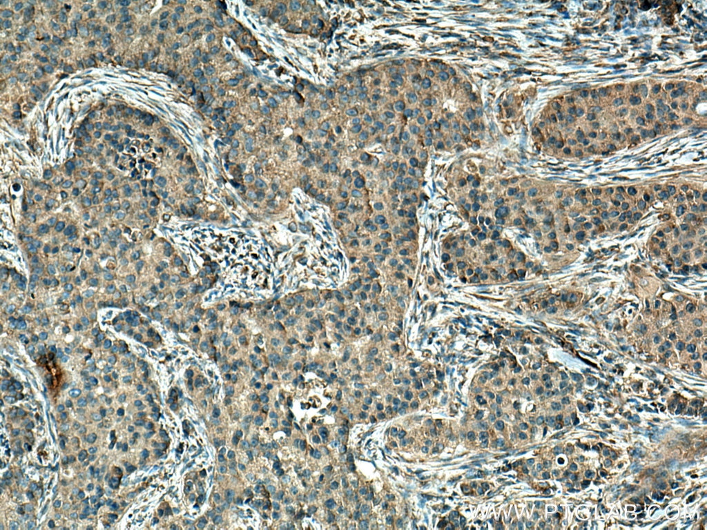 Immunohistochemistry (IHC) staining of human breast cancer tissue using Cytokeratin 10-specific Polyclonal antibody (16855-1-AP)