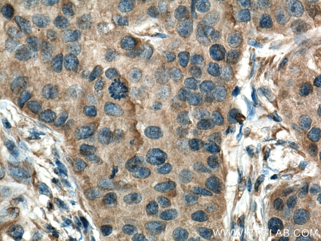 Immunohistochemistry (IHC) staining of human breast cancer tissue using Cytokeratin 10-specific Polyclonal antibody (16855-1-AP)