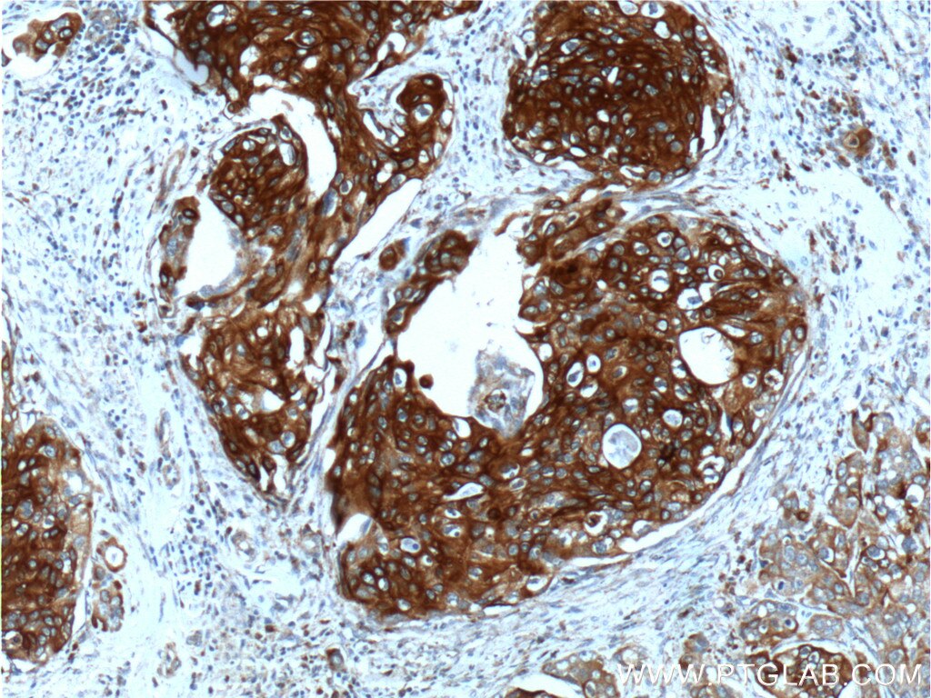 Immunohistochemistry (IHC) staining of human cervical cancer tissue using Cytokeratin 13 Polyclonal antibody (10164-2-AP)