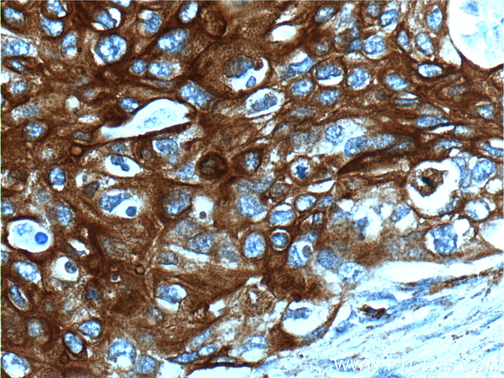 Immunohistochemistry (IHC) staining of human cervical cancer tissue using Cytokeratin 13 Polyclonal antibody (10164-2-AP)