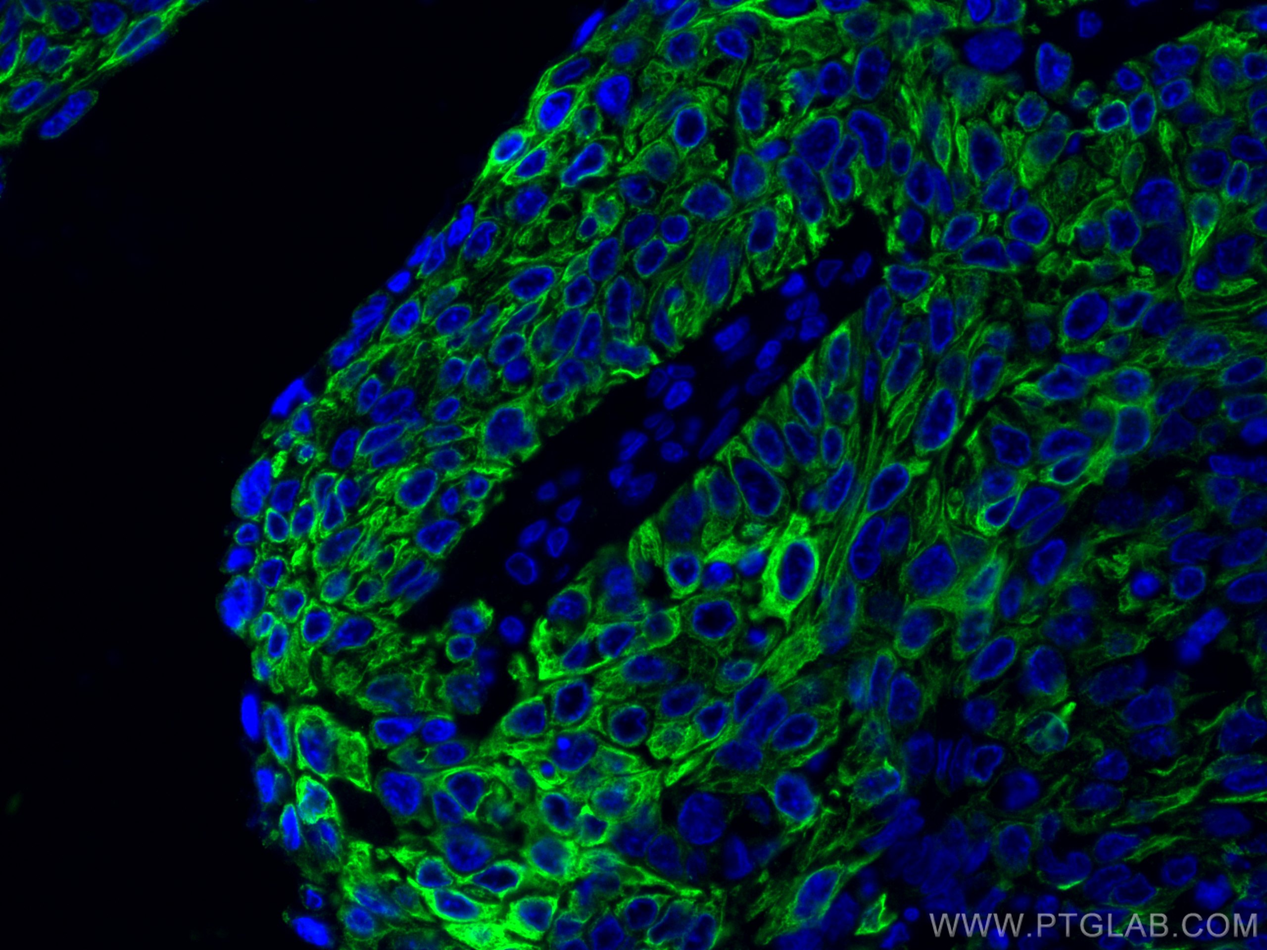 Immunofluorescence (IF) / fluorescent staining of human cervical cancer tissue using Cytokeratin 13 Monoclonal antibody (66684-1-Ig)