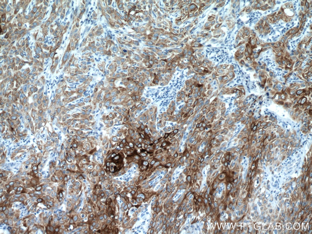 IHC staining of human cervical cancer using 66684-1-Ig