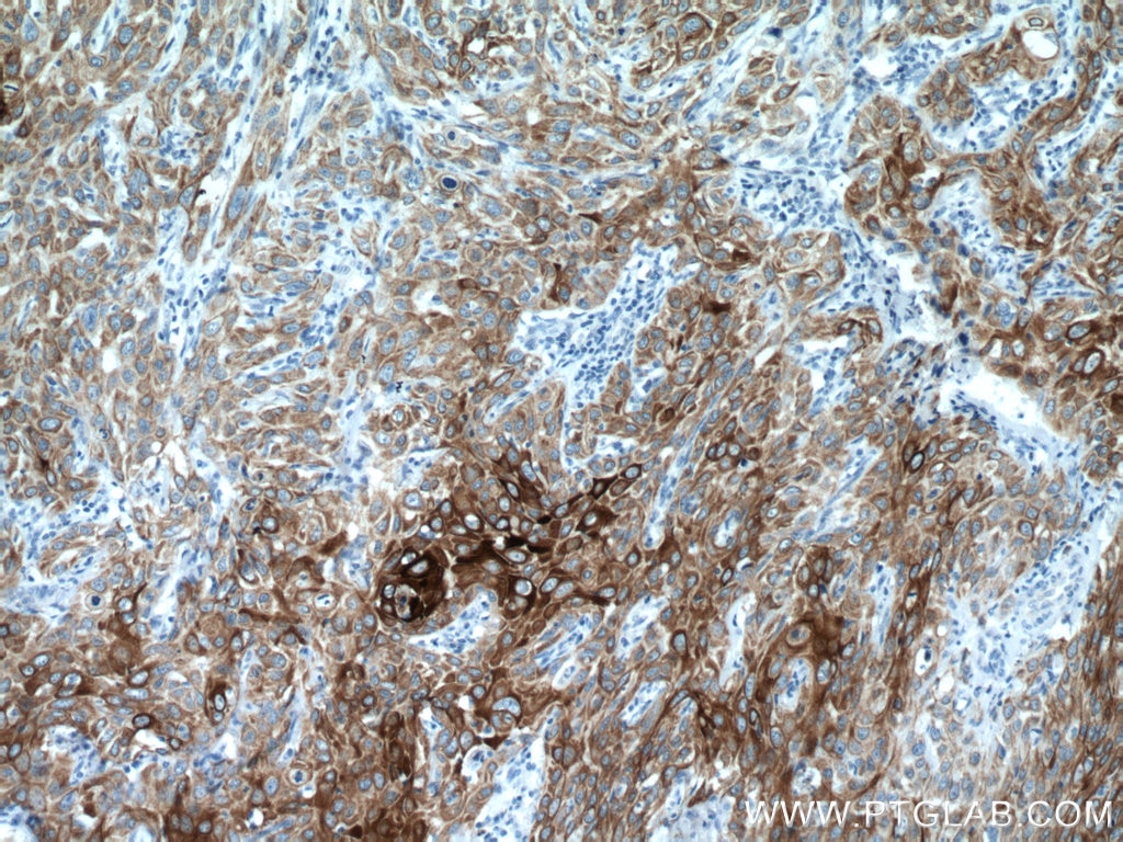 Immunohistochemistry (IHC) staining of human cervical cancer tissue using Cytokeratin 13 Monoclonal antibody (66684-1-Ig)