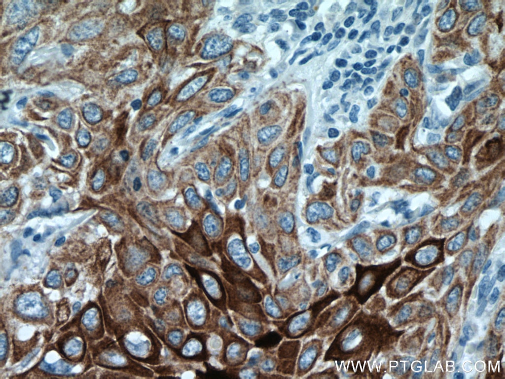 Immunohistochemistry (IHC) staining of human cervical cancer tissue using Cytokeratin 13 Monoclonal antibody (66684-1-Ig)