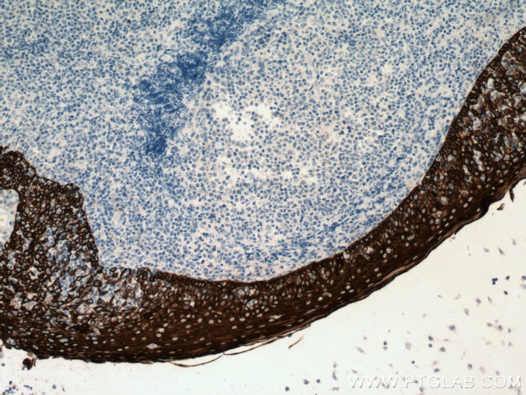 Immunohistochemistry (IHC) staining of human tonsillitis tissue using Cytokeratin 13 Monoclonal antibody (66684-1-Ig)