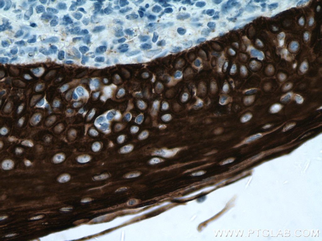 Immunohistochemistry (IHC) staining of human tonsillitis tissue using Cytokeratin 13 Monoclonal antibody (66684-1-Ig)