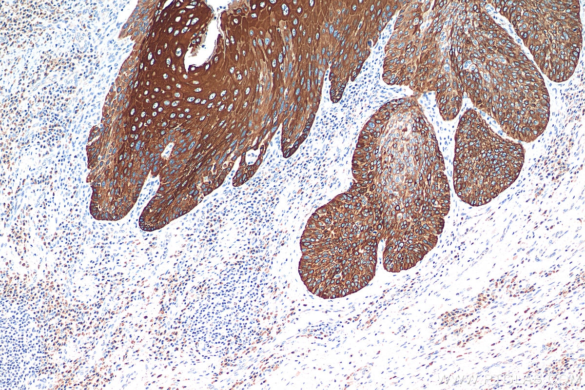 Immunohistochemistry (IHC) staining of human oesophagus cancer tissue using Cytokeratin 13 Monoclonal antibody (66684-1-Ig)