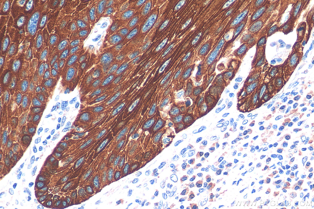 Immunohistochemistry (IHC) staining of human oesophagus cancer tissue using Cytokeratin 13 Monoclonal antibody (66684-1-Ig)