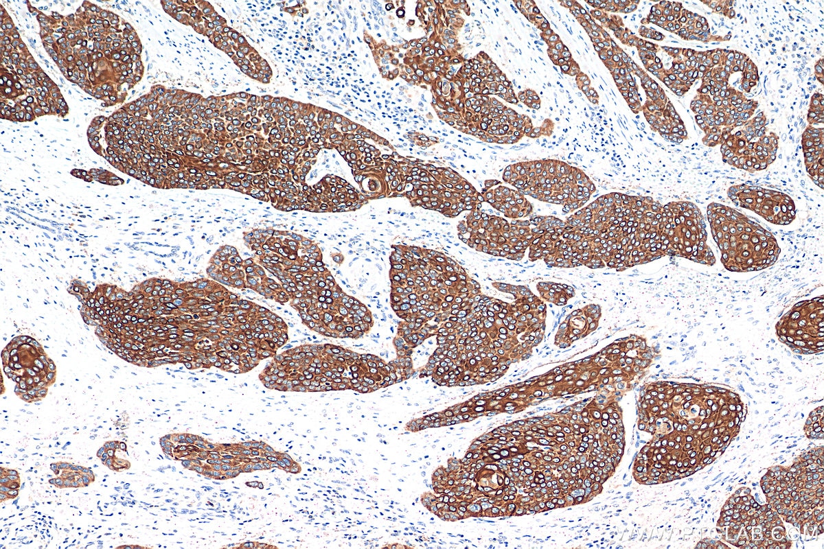 Immunohistochemistry (IHC) staining of human oesophagus cancer tissue using Cytokeratin 13 Monoclonal antibody (66684-1-Ig)