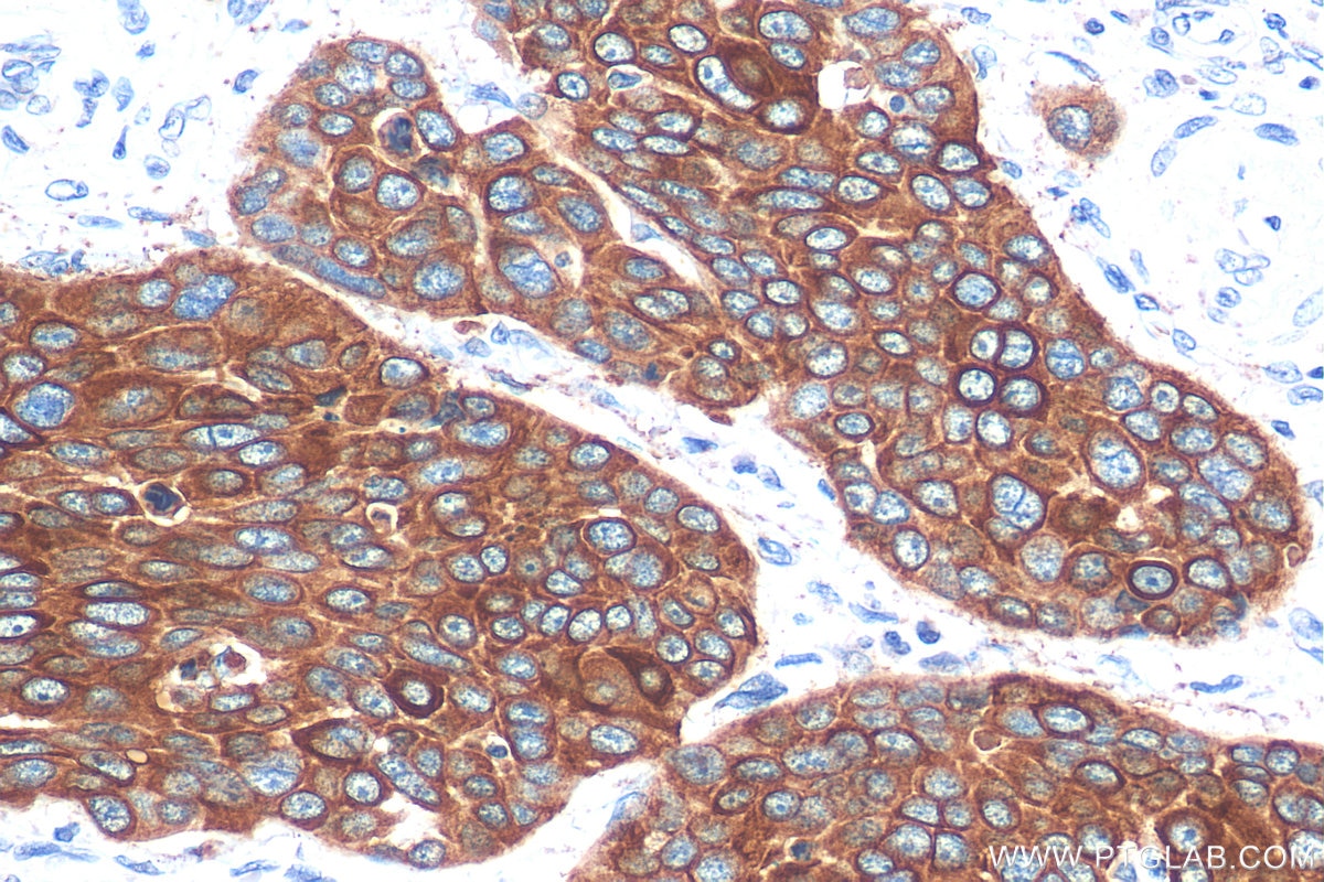 Immunohistochemistry (IHC) staining of human oesophagus cancer tissue using Cytokeratin 13 Monoclonal antibody (66684-1-Ig)