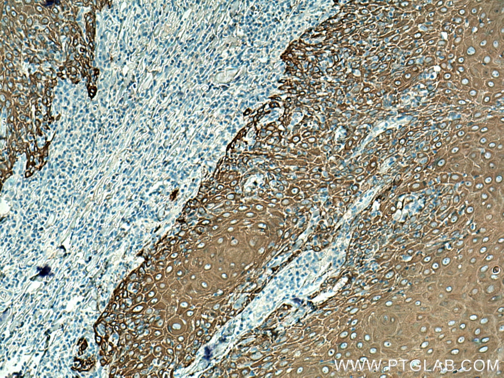 Immunohistochemistry (IHC) staining of human skin cancer tissue using Cytokeratin 14 Polyclonal antibody (10143-1-AP)