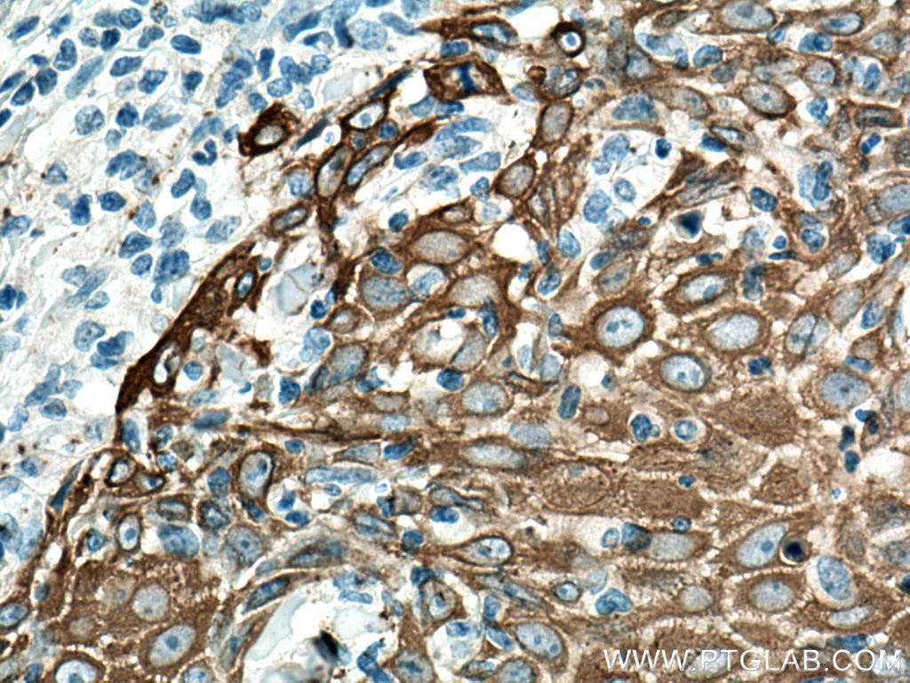Immunohistochemistry (IHC) staining of human skin cancer tissue using Cytokeratin 14 Polyclonal antibody (10143-1-AP)