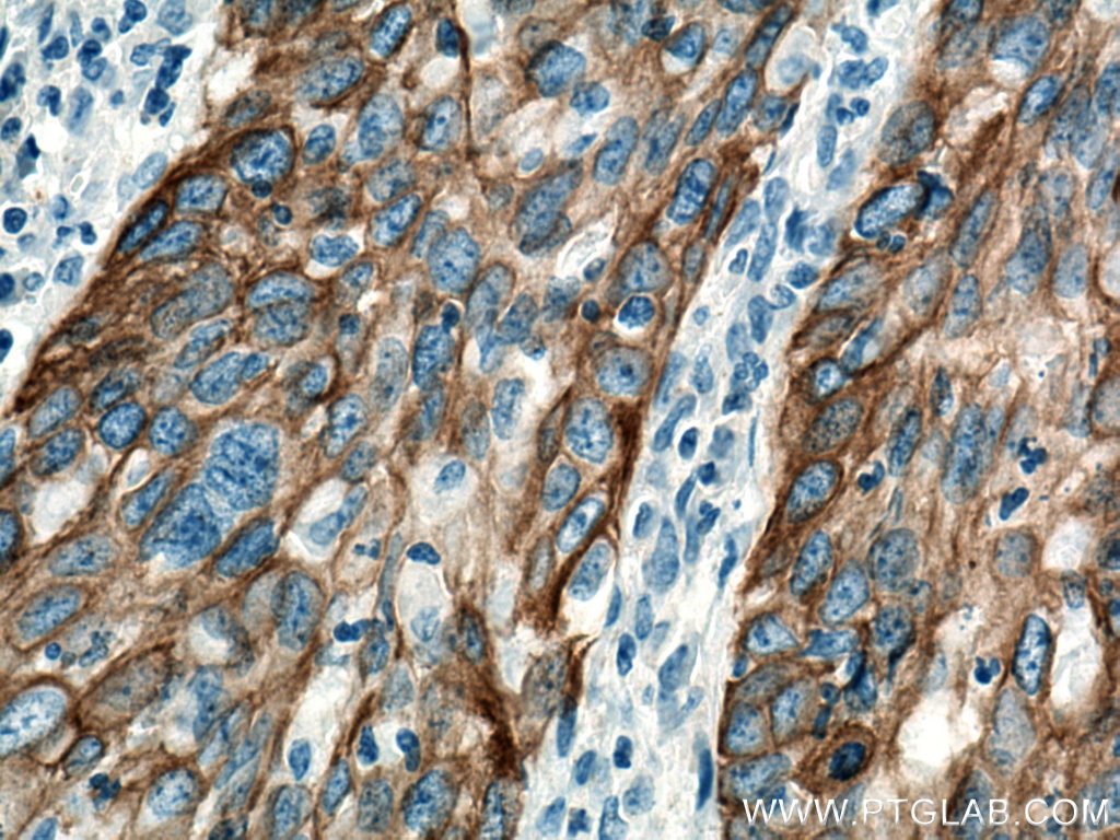 Immunohistochemistry (IHC) staining of human cervical cancer tissue using Cytokeratin 14 Polyclonal antibody (10143-1-AP)