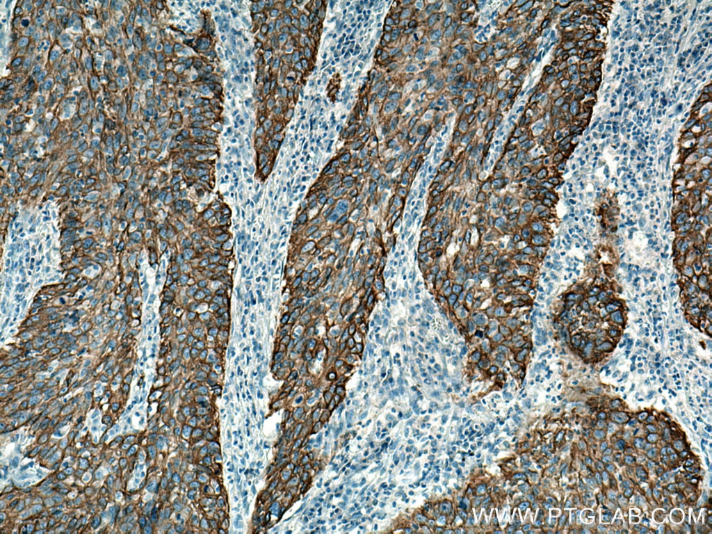 IHC staining of human cervical cancer using 10143-1-AP