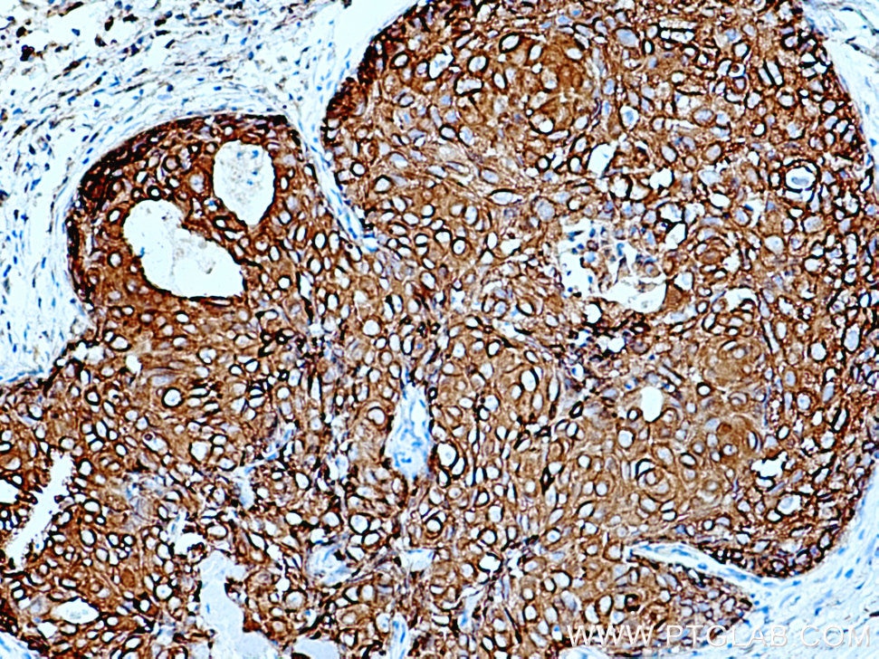 IHC staining of human breast cancer using 10143-1-AP