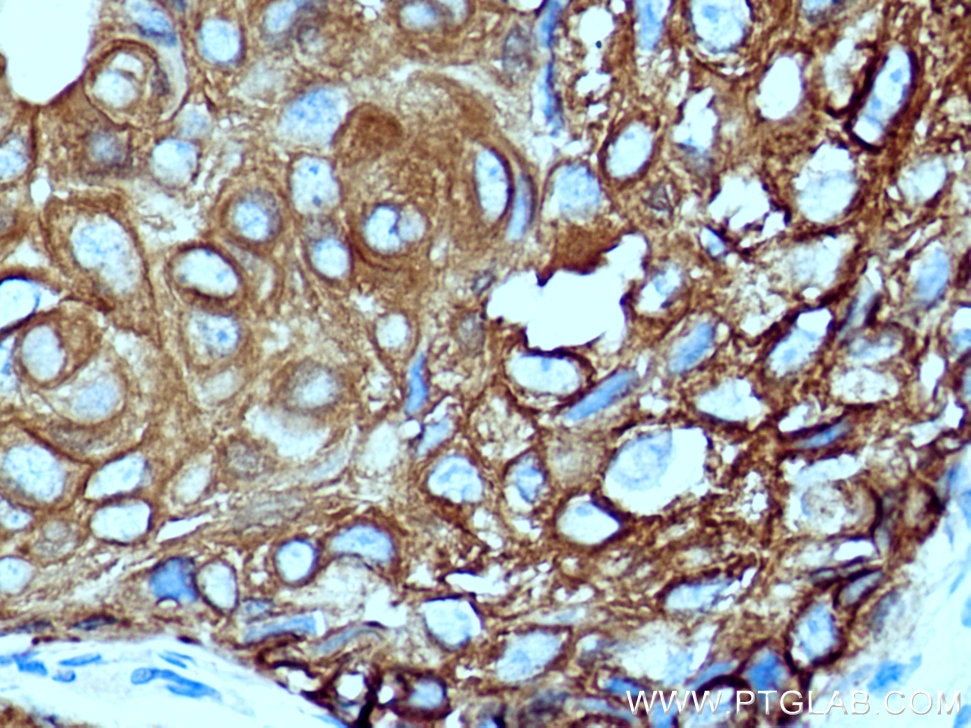 Immunohistochemistry (IHC) staining of human breast cancer tissue using Cytokeratin 14 Polyclonal antibody (10143-1-AP)