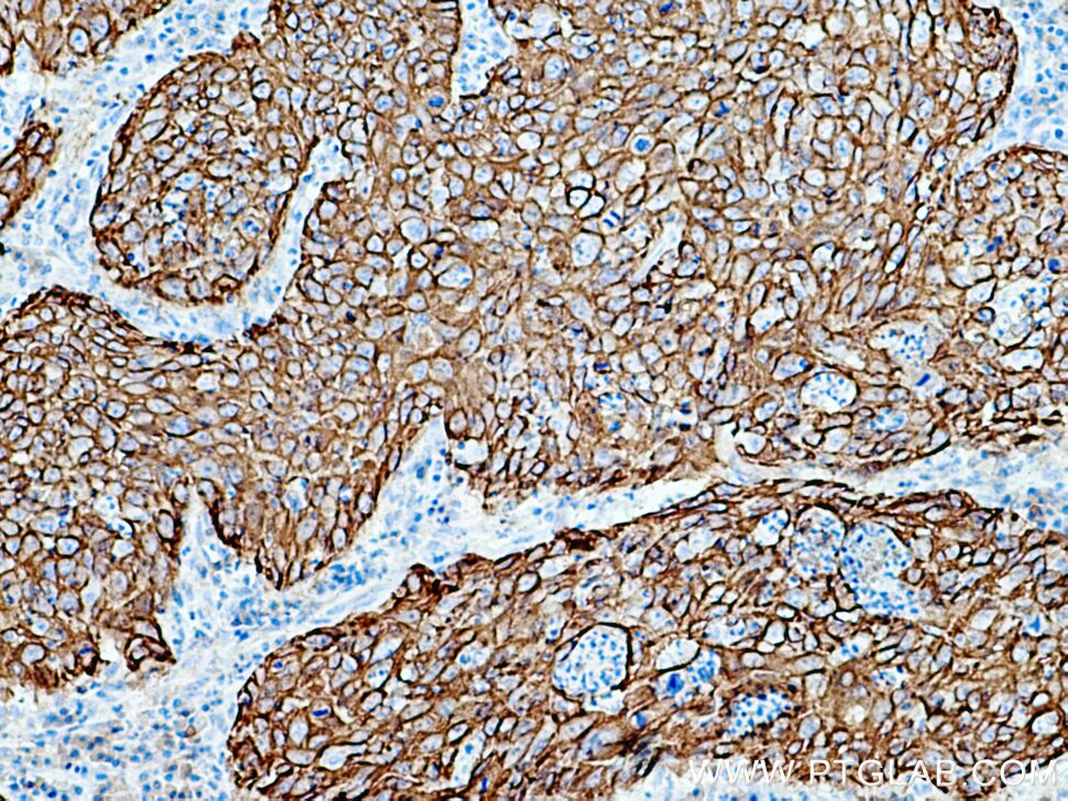 IHC staining of human cervical cancer using 10143-1-AP